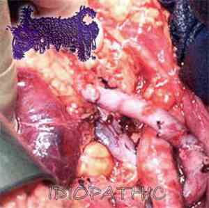 Lymphatic Secretion - Idiopathic