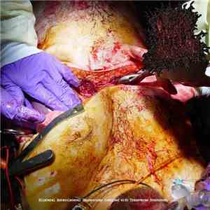 Vomiting Through An Infected Tracheotomy - Bilateral Anterolateral Thoracot ...
