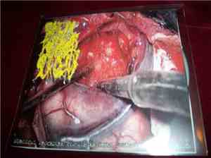 Pineal Tumor Surgery - Surgical Procedure Via Subtentorial Supracerebellar  ...