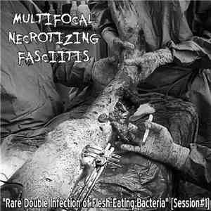 Multifocal Necrotizing Fasciitis - Rare Double Infection Of Flesh​-​Eating Bacteria