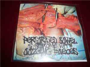 Perforated Bowel Syndrome With Oozing Faeces - Incomplete Bowelectomy
