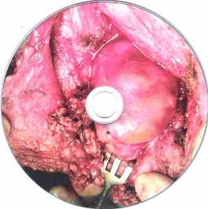 Carcinosarcoma - Pathogenesis Beyond The Evil